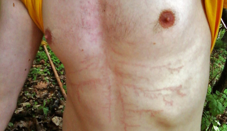 Muž zasažený bleskem.