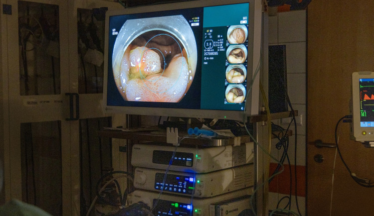 Hradecká nemocnice umí lépe diagnostikovat rakovinu střev. Pomáhají nové přístroje